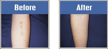 1keloid_resize.jpg